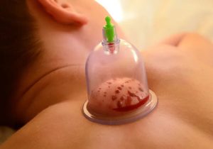 حجامت در تبریز