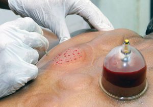 حجامت در مشهد