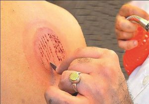 حجامت در کرج