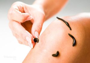 زالو درمانی در مشهد