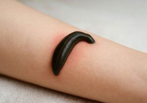 زالو درمانی در کرج