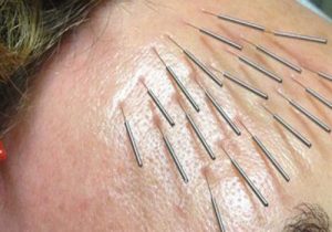 طب سوزنی در تبریز